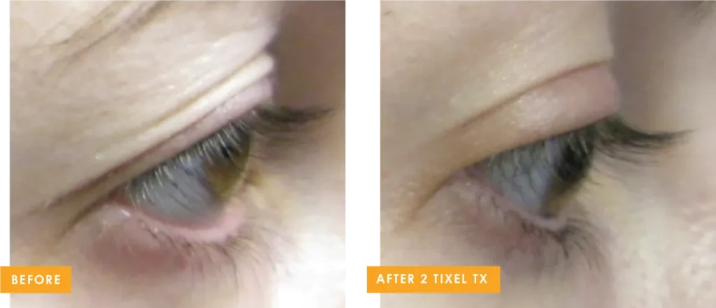 tixel b and a 3