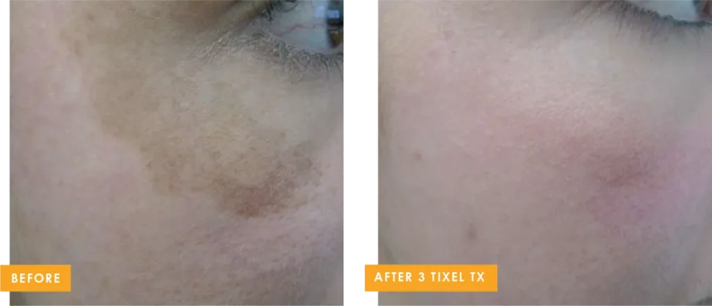 tixel b and a 4