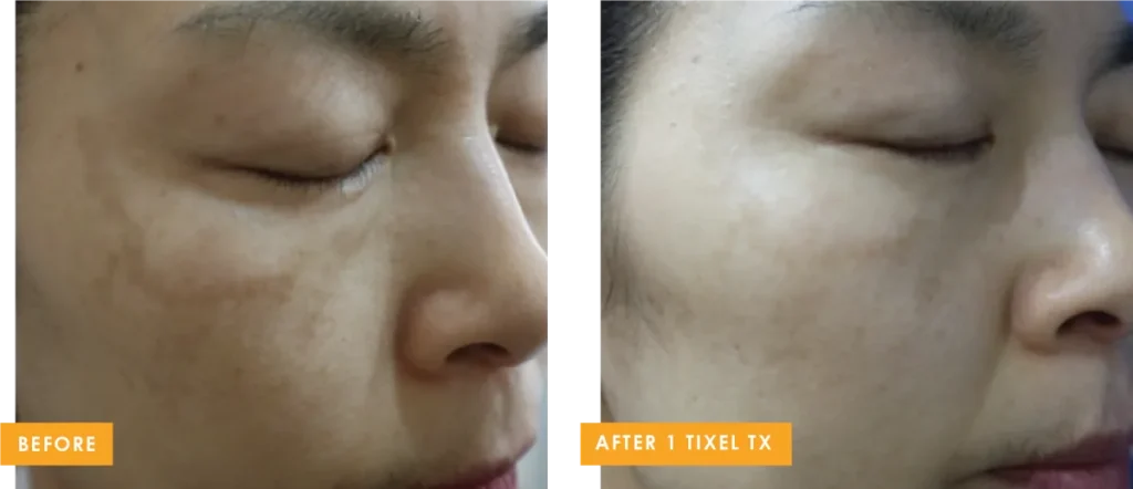 tixel b and a 5