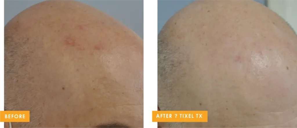 tixel b and a 7
