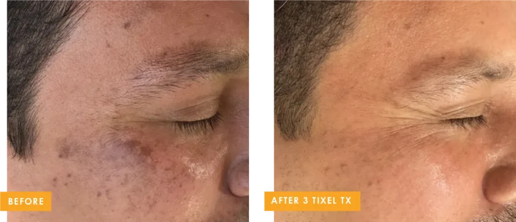 tixel b and a 8